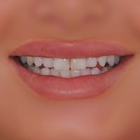 Composite Bonding - Smile 14 before